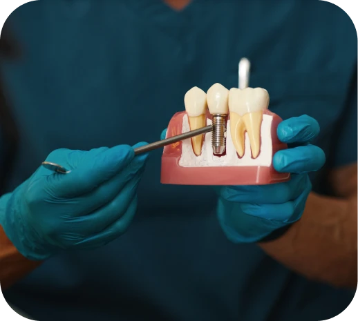 Implantes dentales