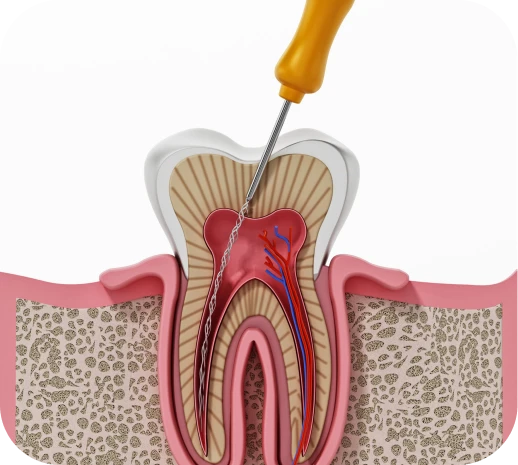 Endodoncia